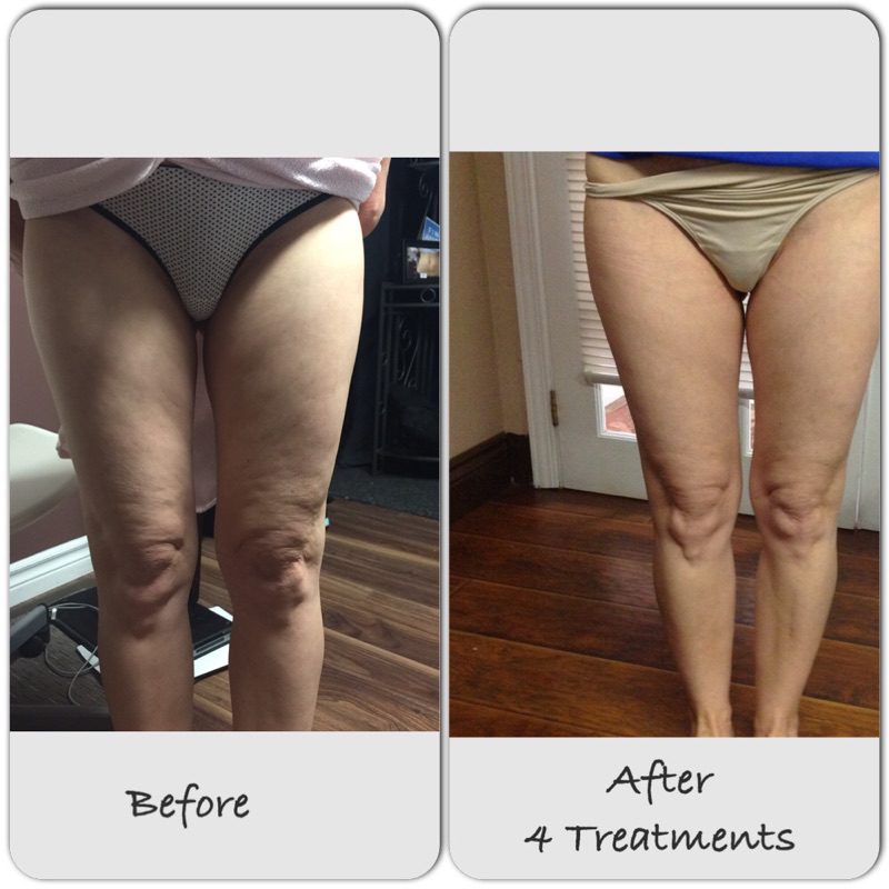 cellulite reduction treatments windsor