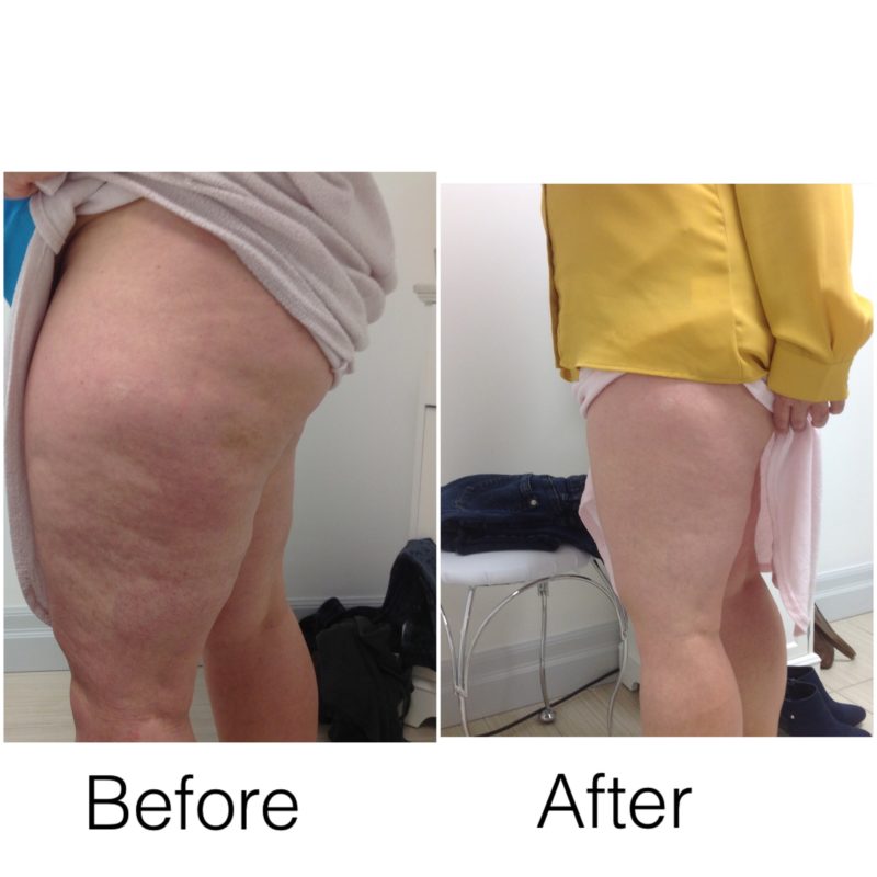 cellulite reduction treatments windsor