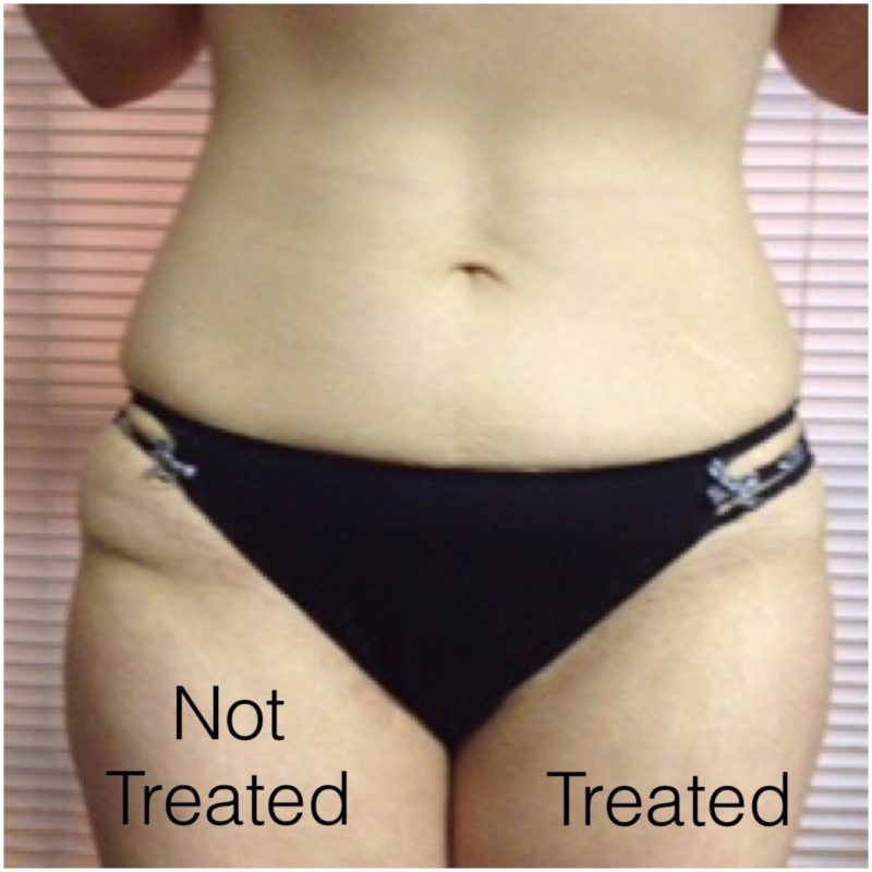 cellulite reduction treatments windsor