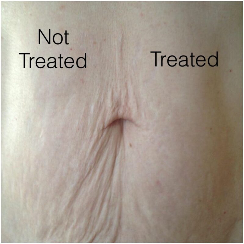 Laser Skin Tightening Windsor