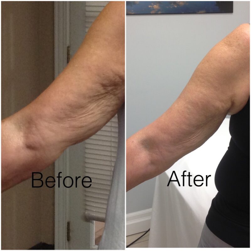 Laser Skin Tightening Windsor