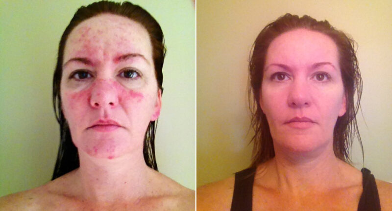 Rosacea Skin Treatment Windsor