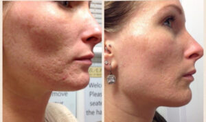 Skin Laser Resurfacing Windsor