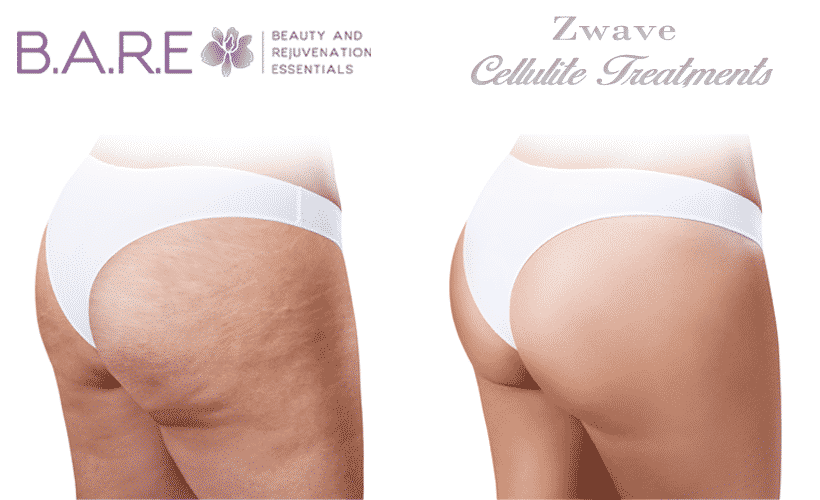 Cellulite Reduction Treatment Windsor