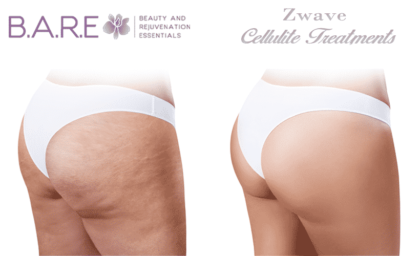 Cellulite Reduction Treatment Windsor Ontario