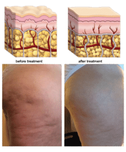 Cellulite Reduction Treatment Zwave