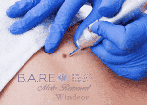 Mole Removal in Windor