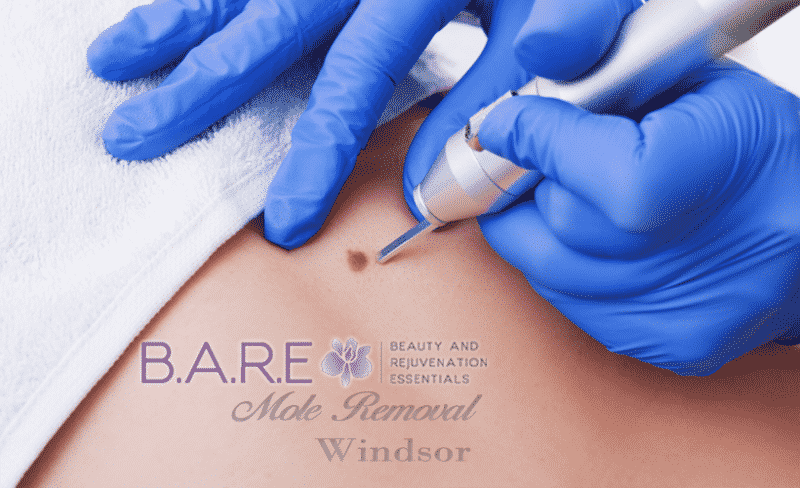 Mole Removal in Windor