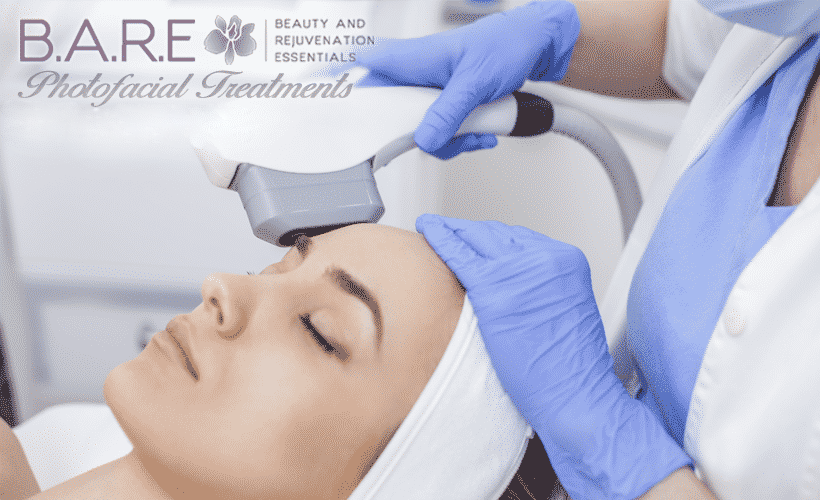 Photofacial Treatments Tecumseh