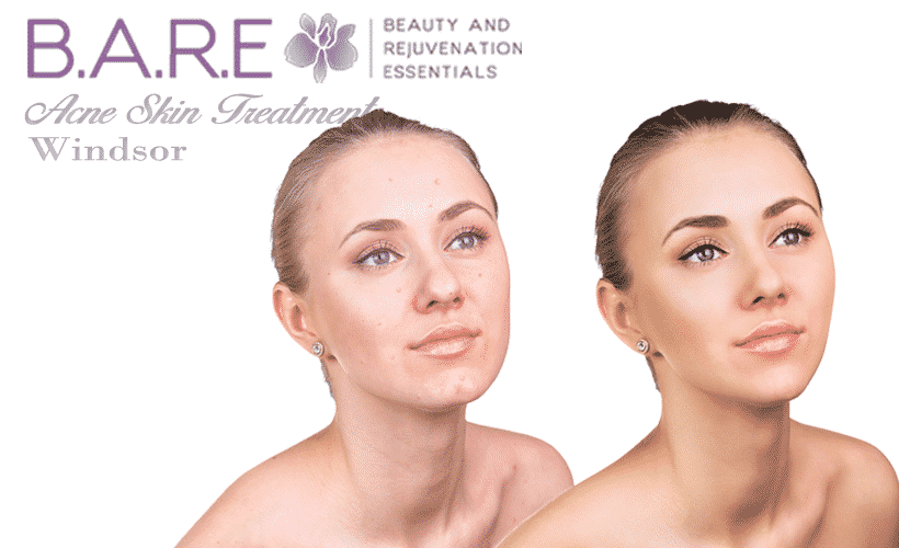 Acne Treatments in Tecumseh