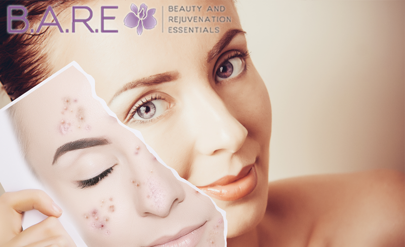 Acne scar laser treatments