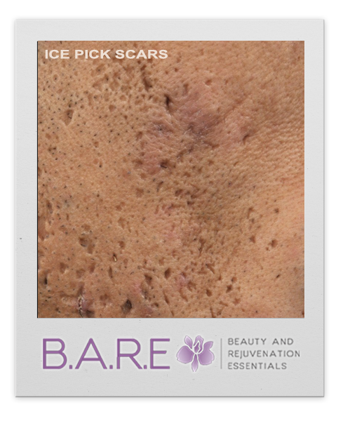 Ice Pick Acne Scars