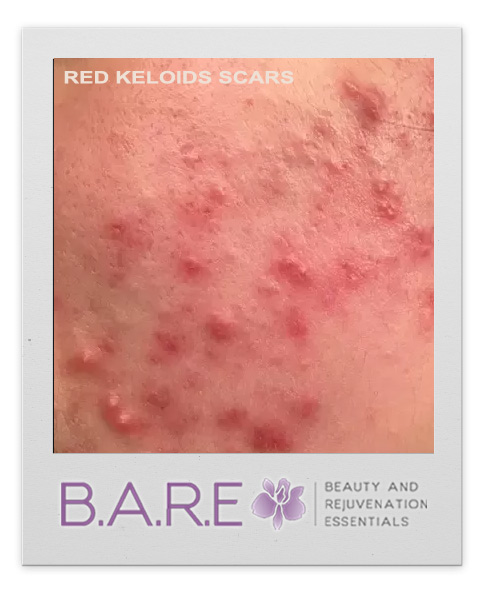 Red Keloids Acne Scars