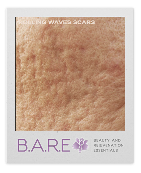 Rolling Waves Acne Scars