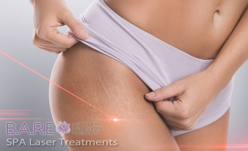 SPA Laser Treatments in Windsor Ontario