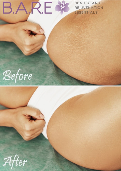 IPL for Stretch Marks Before & After