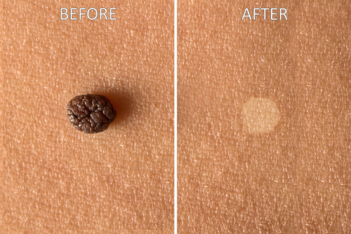Skin Tag Before After Removal