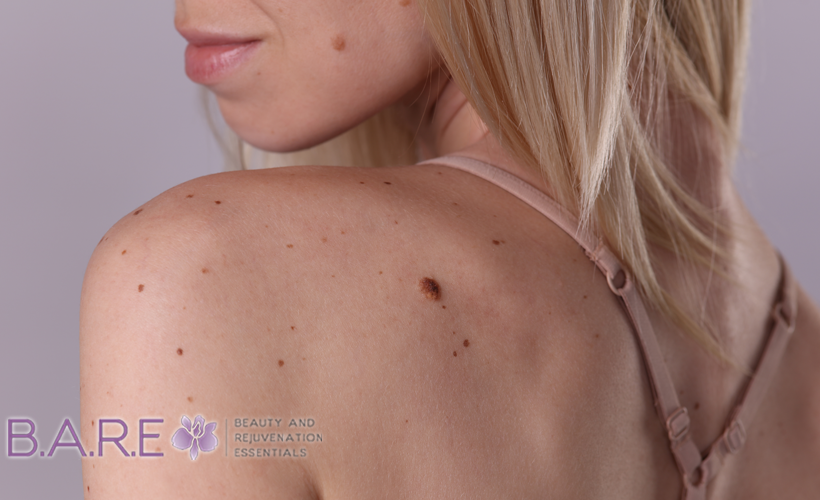 Skin Tag Removal in Windsor