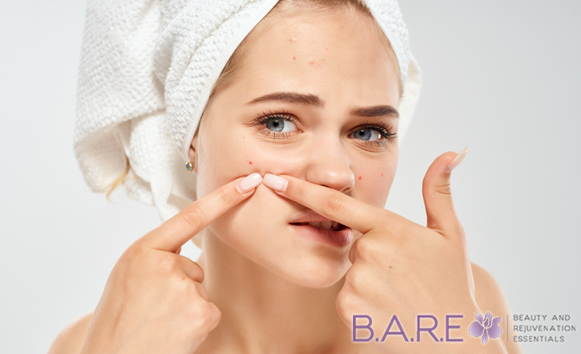 acne prevention laser treatments amherstburg