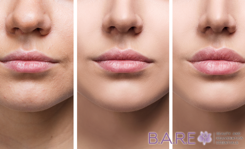 Cosmetic Injections in Windsor