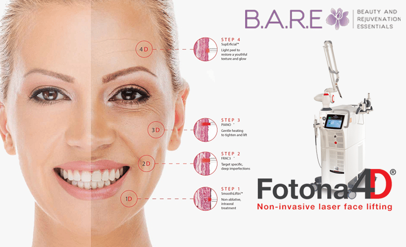 Fotona 4D Laser Treatment in Tecumseh