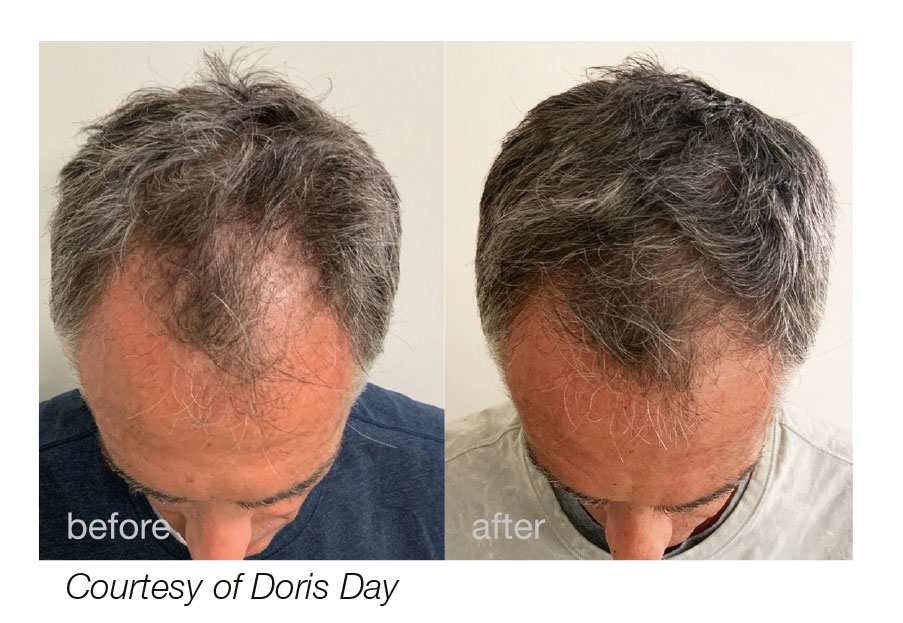 Fotona HairStart Restoration