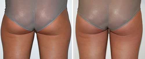 lipolysis Before and After1