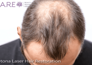 Laser Hair Restoration Fotona