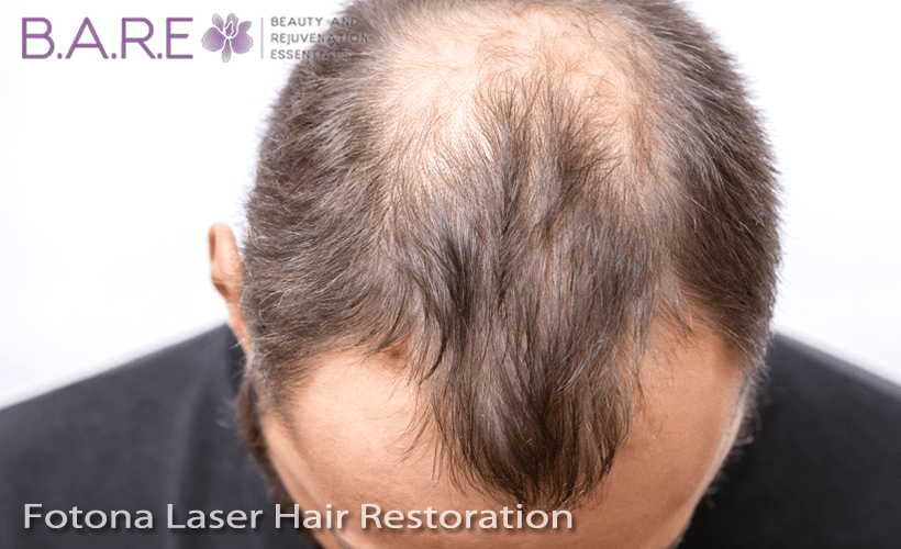 Laser Hair Restoration Fotona