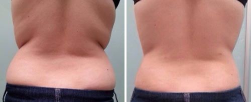 tightsculpting before and after