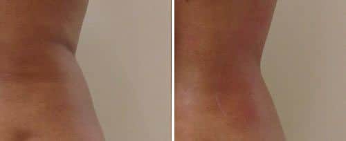 tightsculpting before and after2