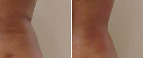 tightsculpting before and after2