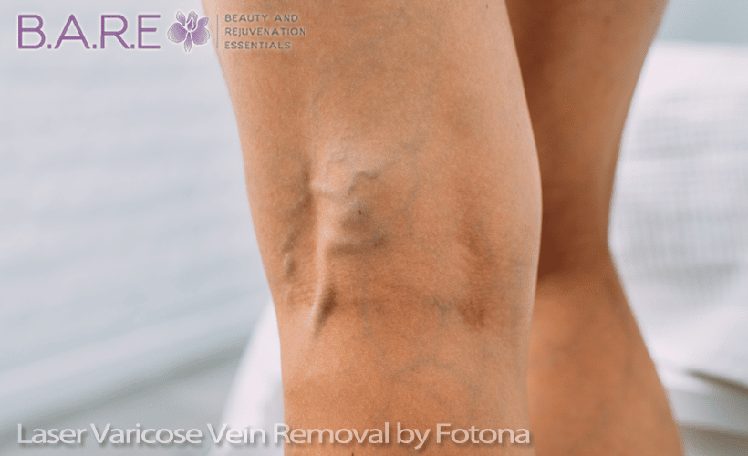 Laser Varicose Vein Removal