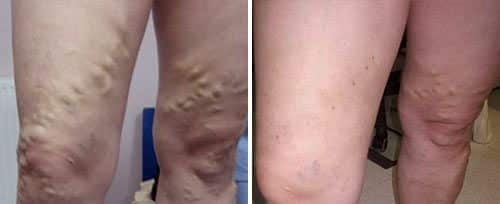 Varicose Veins Before and After