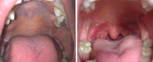 nightlase mouth structure