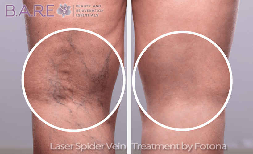 laser spider vein removal treatments