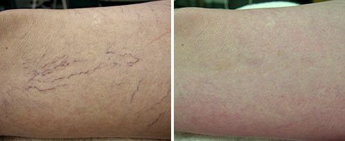 spider veins before and after laser treatment