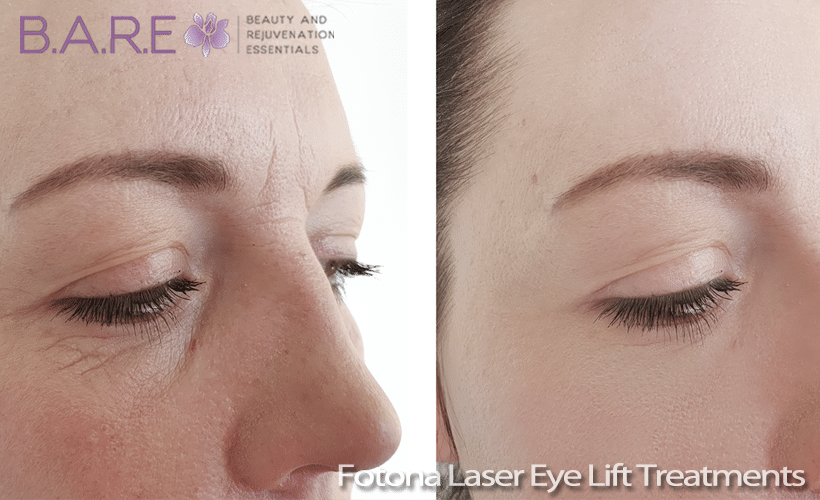 SmoothEYE Laser Eye Lift Treatments
