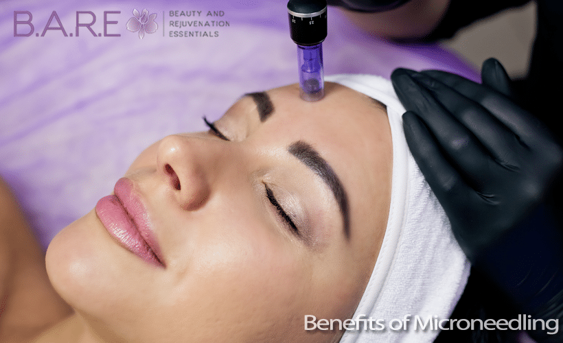 Benefits of Microneedling for your face