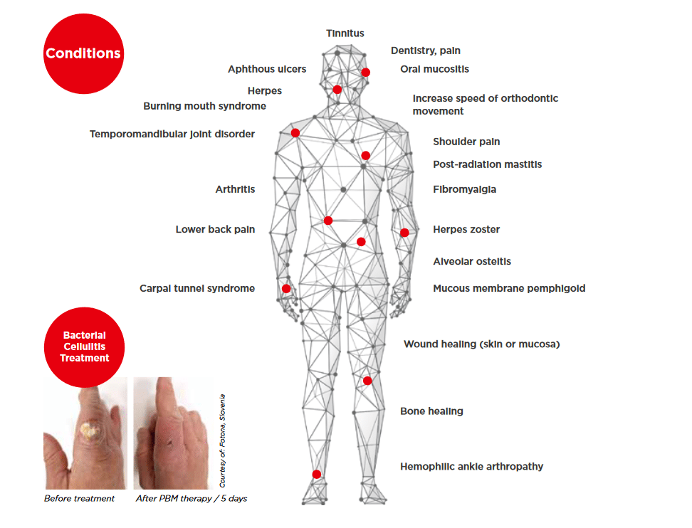 ComfortLase Healing Conditions