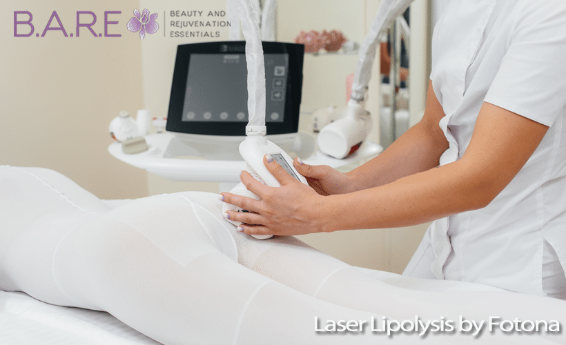 laser lipolysis Fotona