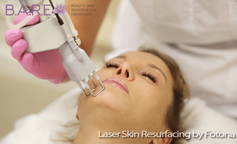 laser skin resurfacing tecumseh