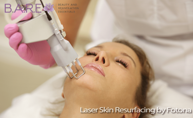 Laser Skin Resurfacing Tecumseh