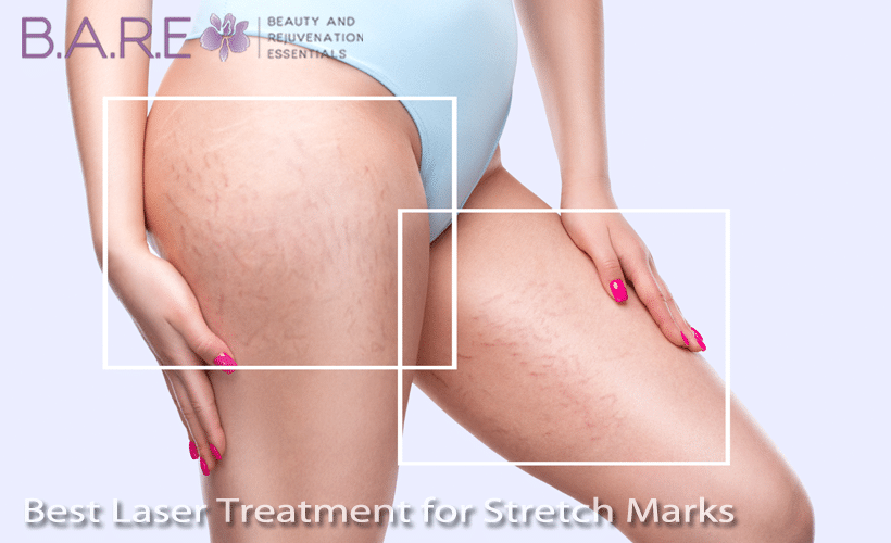 Laser Treatment for Stretch Marks in Windsor