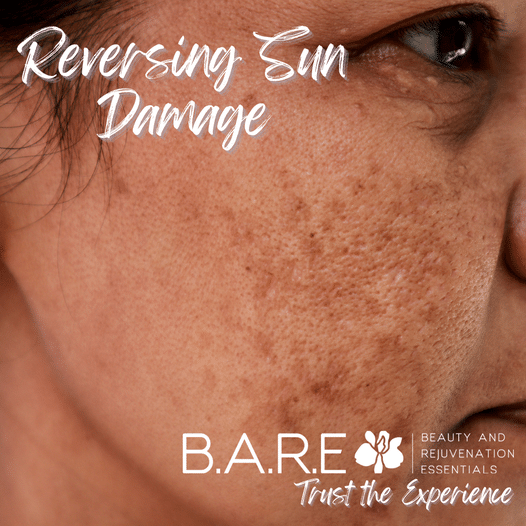 Reverse Sun Damaged Skin