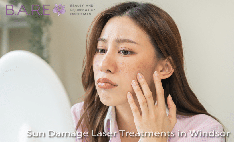 Sun Damage Laser Treatments Windsor