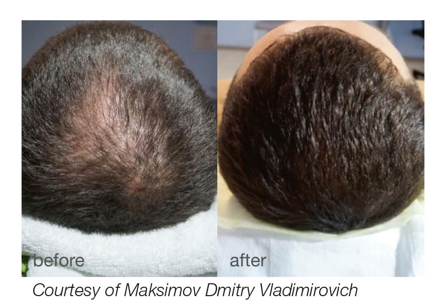 Rejuvenation Treatments for Hair Growth