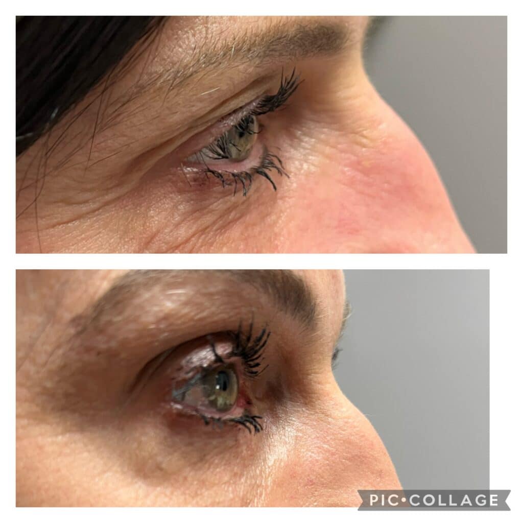 Thermage Crows Feet Tightening Results