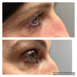 Thermage Crows Feet Tightening Results
