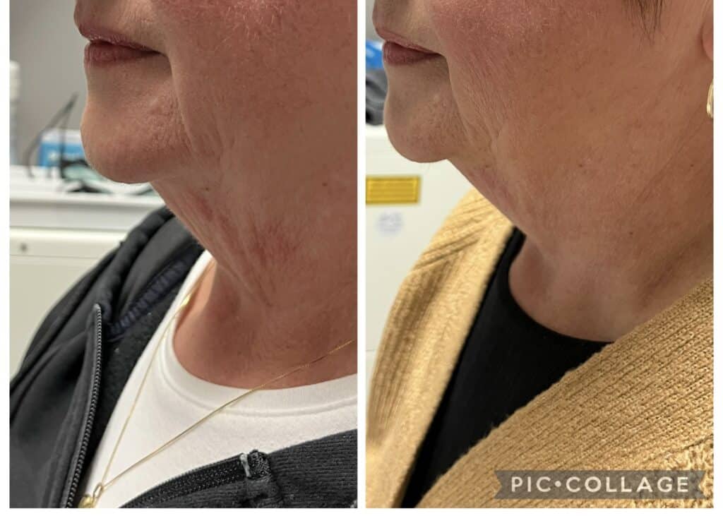Thermage Neck Tightening Results